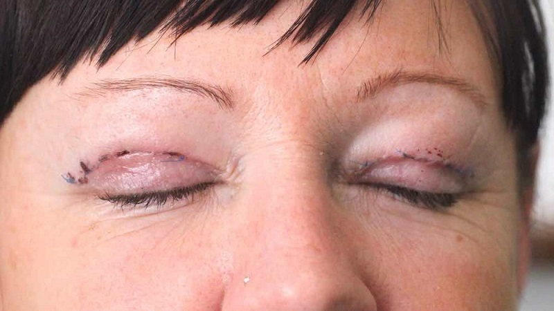 Sửa mí mắt không cân đối bằng cách khâu tái tạo