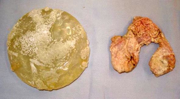 nâng ngực bao lâu bị bao xơ