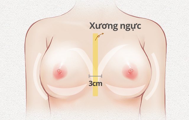 nâng ngực yline là gì