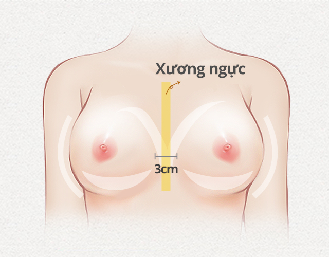 nâng ngực yline là gì