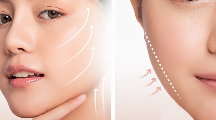 căng da mặt giá bao nhiêu tiền