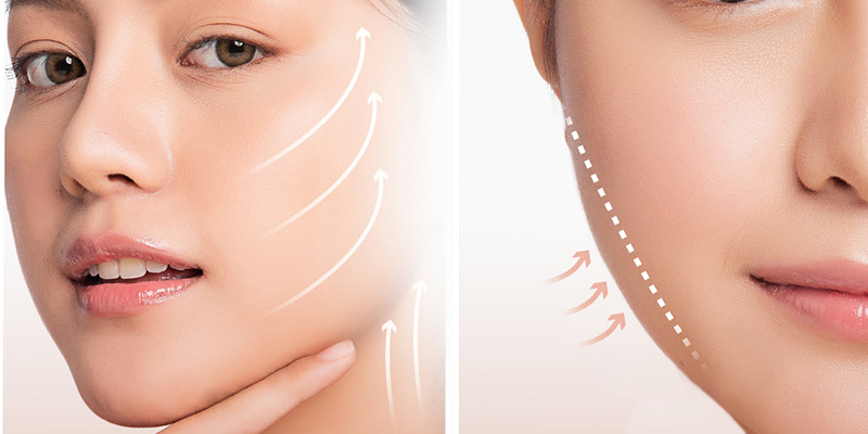 căng da mặt giá bao nhiêu tiền