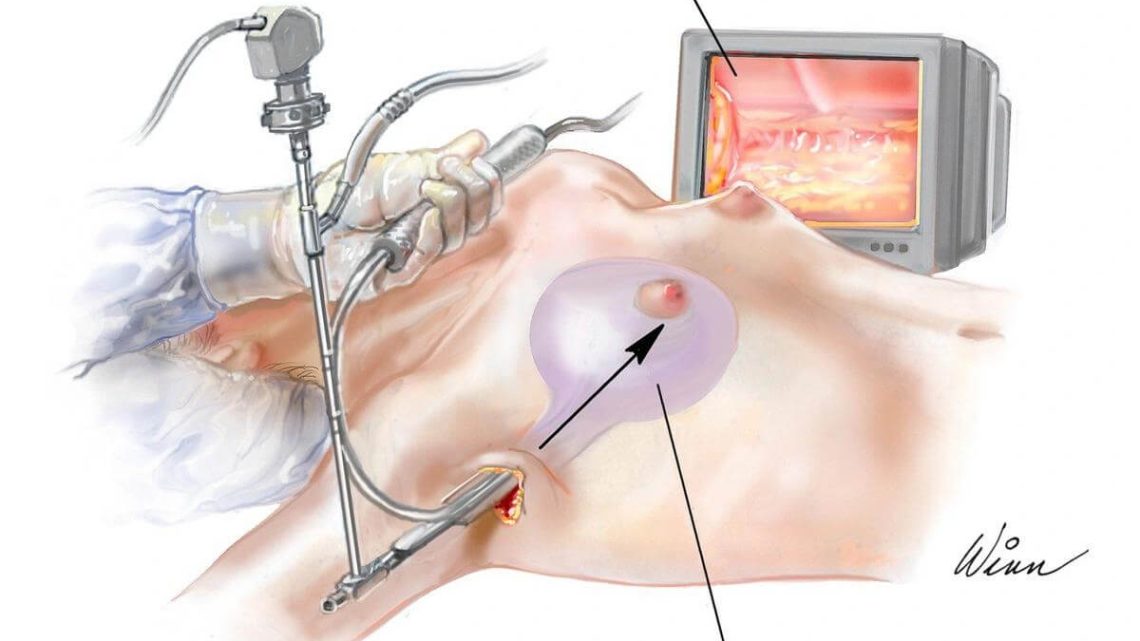 nâng ngực đường nách