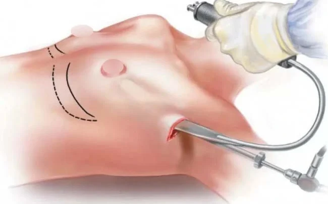 nâng ngực nội soi