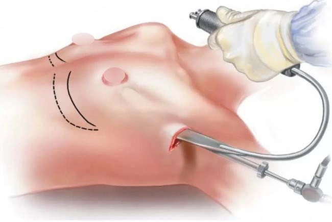 nâng ngực nội soi