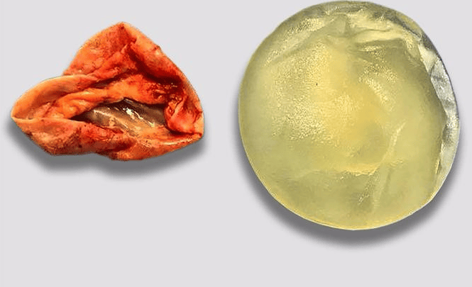 vì sao nâng ngực bị bao xơ