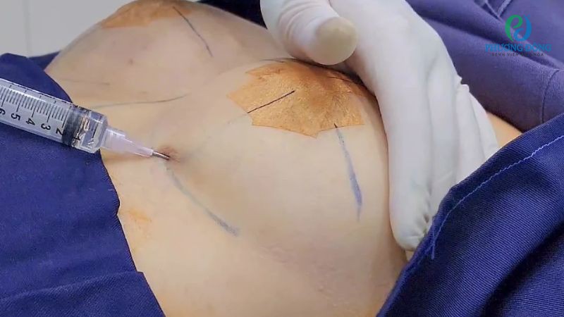 Nâng ngực không phẫu thuật có được không? 2 nâng ngực không phẫu thuật có được không