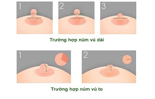 thu nhỏ đầu ti có sao không
