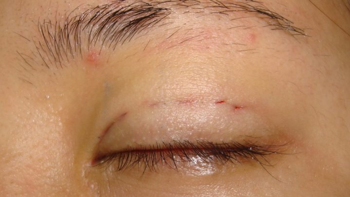 chắm sóc sau bấm mí mắt