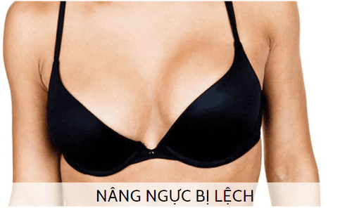 ngực nâng không đều phải làm sao