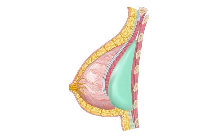 Nâng ngực đặt túi sau này có bị xệ không? Bác sĩ giải đáp 2 nâng ngực đặt túi